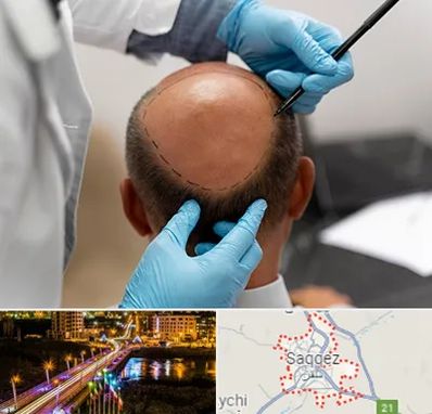 آموزش کاشت مو در سقز