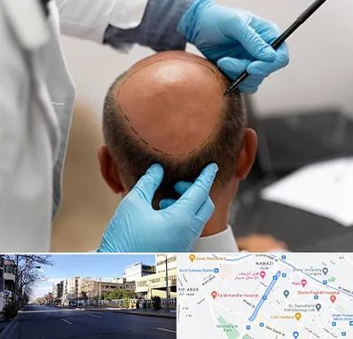 آموزش کاشت مو در خیابان ملاصدرا شیراز 