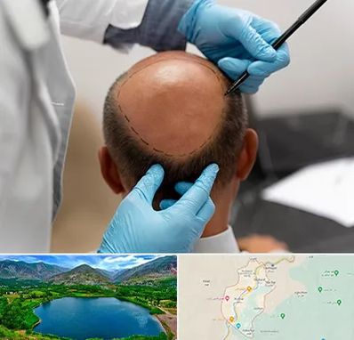 آموزش کاشت مو در رودبار
