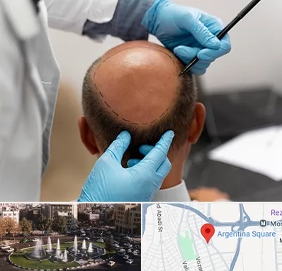 آموزش کاشت مو در آرژانتین