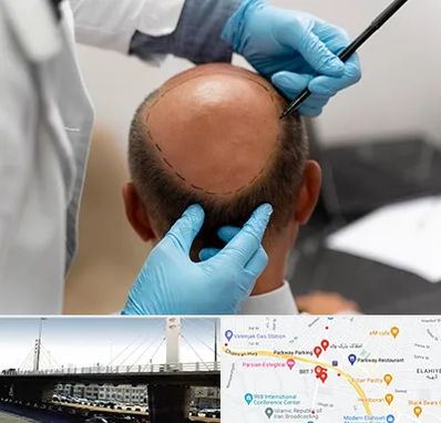 آموزش کاشت مو در پارک وی 