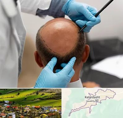 آموزش کاشت مو در کلاردشت