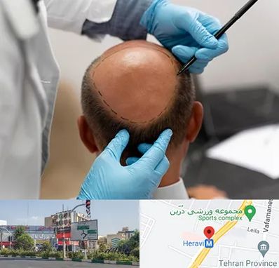 آموزش کاشت مو در هروی 