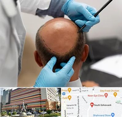 آموزش کاشت مو در سهروردی 