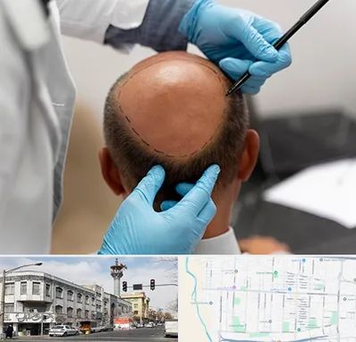 آموزش کاشت مو در 17شهریور