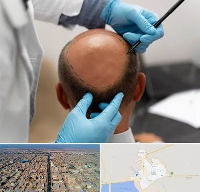 آموزش کاشت مو در بندر ماهشهر