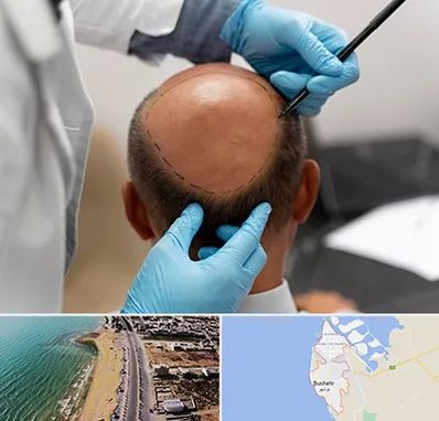 آموزش کاشت مو در بوشهر