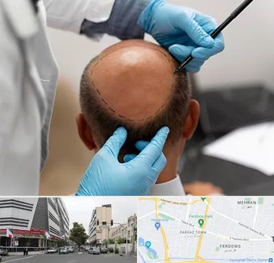 آموزش کاشت مو در بلوار فردوس 