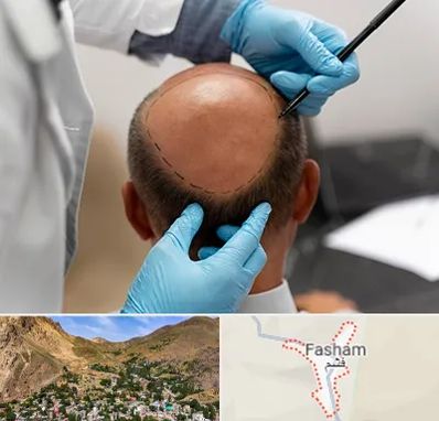 آموزش کاشت مو در فشم