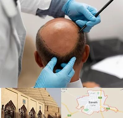 آموزش کاشت مو در ساوه