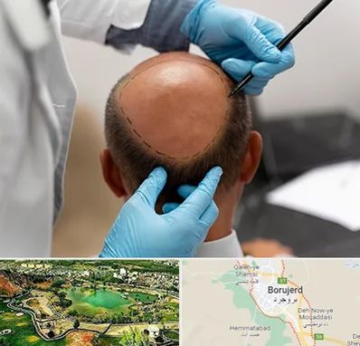 آموزش کاشت مو در بروجرد