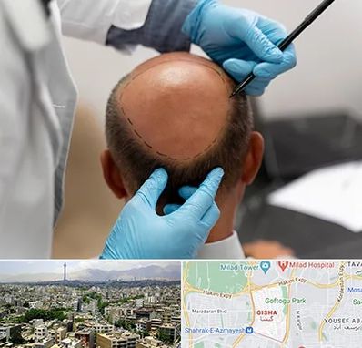 آموزش کاشت مو در گیشا 