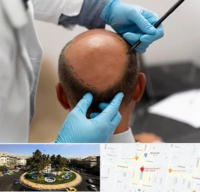 آموزش کاشت مو در هفت حوض 