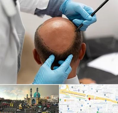 آموزش کاشت مو در رسالت 