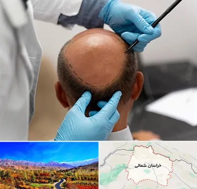 آموزش کاشت مو در خراسان شمالی