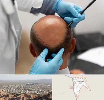 آموزش کاشت مو در اسفراین