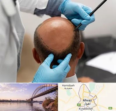 آموزش کاشت مو در اهواز