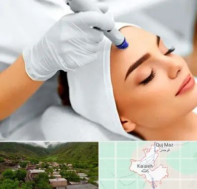 آموزش مزوتراپی در کلاله