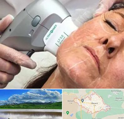 آموزش هایفوتراپی در مرند