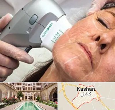 آموزش هایفوتراپی در کاشان