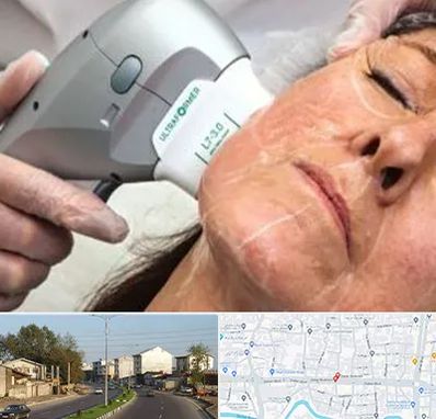 آموزش هایفوتراپی در ضیابری رشت 