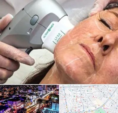 آموزش هایفوتراپی در منظریه رشت 