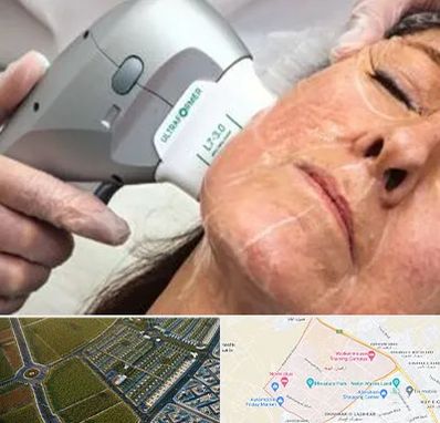 آموزش هایفوتراپی در الهیه مشهد 