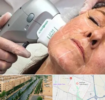 آموزش هایفوتراپی در فاز سه اندیشه