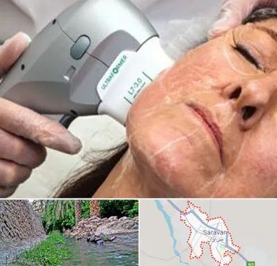 آموزش هایفوتراپی در سراوان