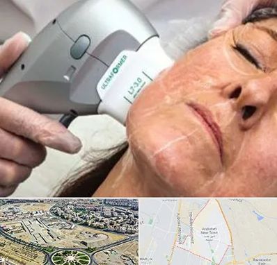 آموزش هایفوتراپی در اندیشه