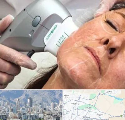 آموزش هایفوتراپی در شمال شرق تهران