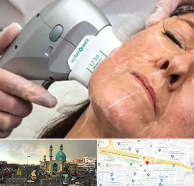 آموزش هایفوتراپی در رسالت 