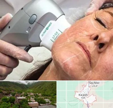 آموزش هایفوتراپی در کلاله