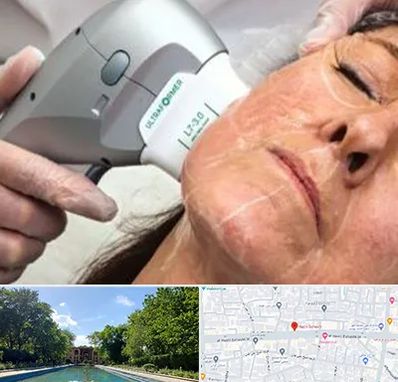 آموزش هایفوتراپی در هشت بهشت اصفهان 