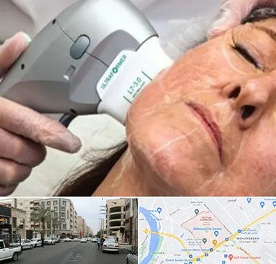 آموزش هایفوتراپی در زیتون کارمندی اهواز 