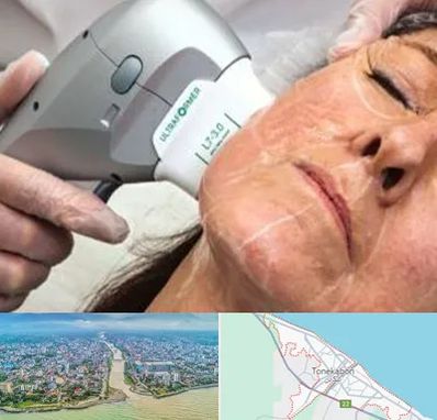 آموزش هایفوتراپی در تنکابن