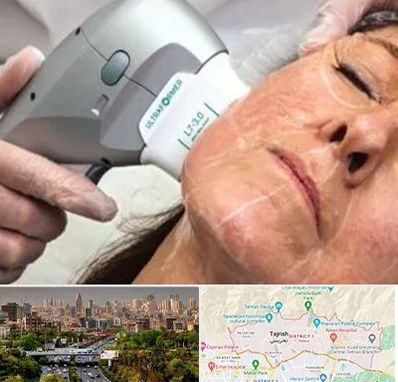 آموزش هایفوتراپی در منطقه 1 تهران 