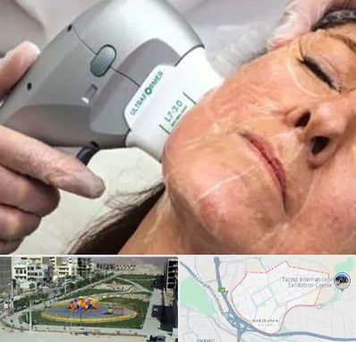 آموزش هایفوتراپی در مرزداران تبریز