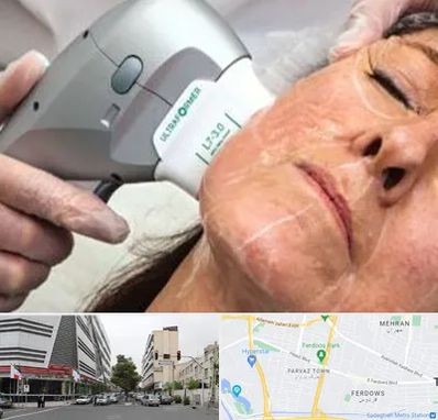 آموزش هایفوتراپی در بلوار فردوس 