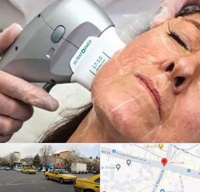 آموزش هایفوتراپی در شهناز تبریز