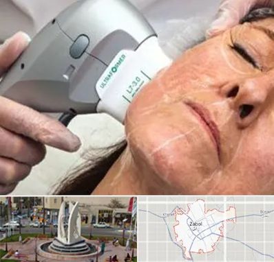 آموزش هایفوتراپی در زابل