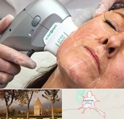 آموزش هایفوتراپی در تویسرکان