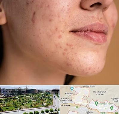 درمان جای جوش در پردیس