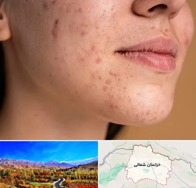 درمان جای جوش در خراسان شمالی