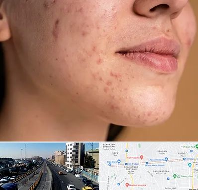 درمان جای جوش در پیروزی 