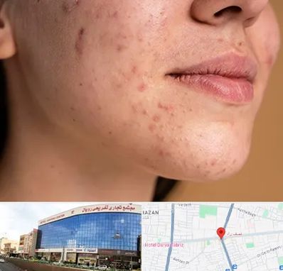 درمان جای جوش در نصف راه تبریز