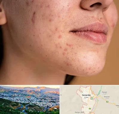 درمان جای جوش در سنندج