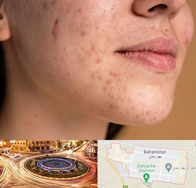 درمان جای جوش در بهارستان