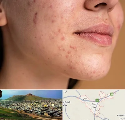 درمان جای جوش در بیجار