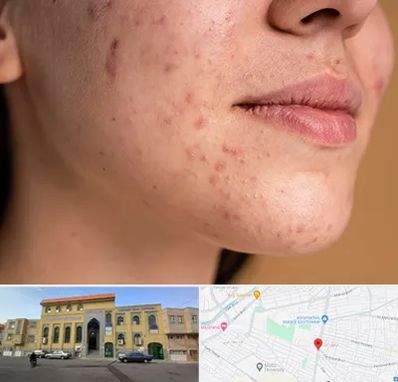 درمان جای جوش در زنبیل آباد قم